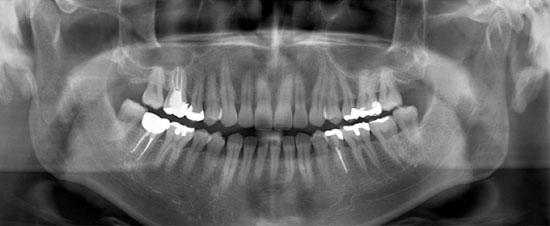 Ренгеновский снимок зубов